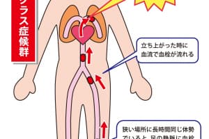 車中泊 仮眠で要注意 意外と知らない エコノミークラス症候群 の恐怖 Auto Messe Web カスタム アウトドア 福祉車両 モータースポーツなどのカーライフ情報が満載